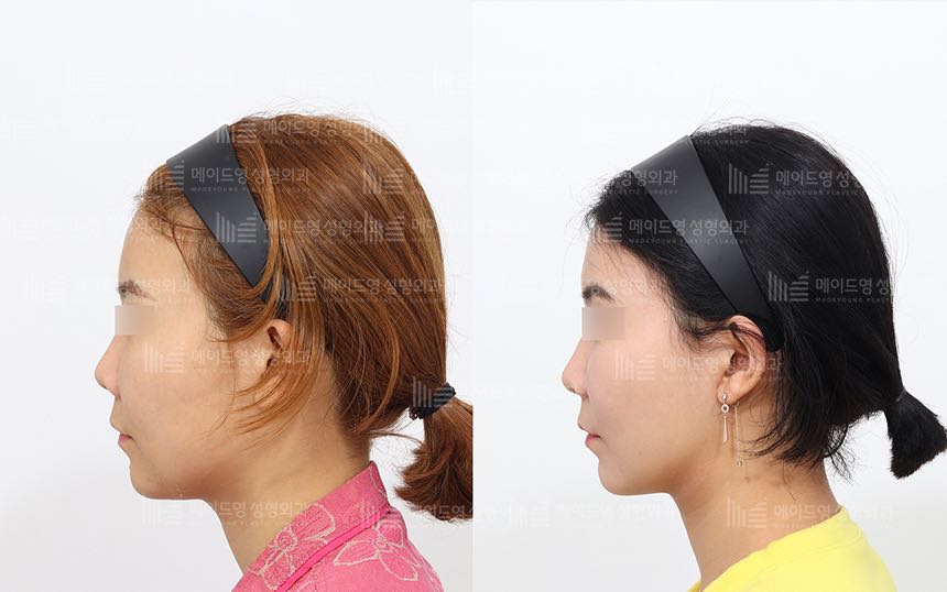 face lifting korea before after pictures - Lifting Before and After