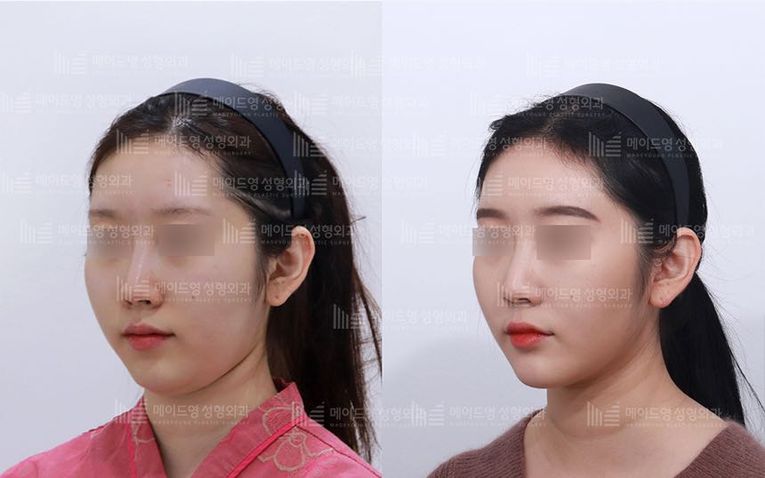face lifting korea before after pictures - Lifting Before and After
