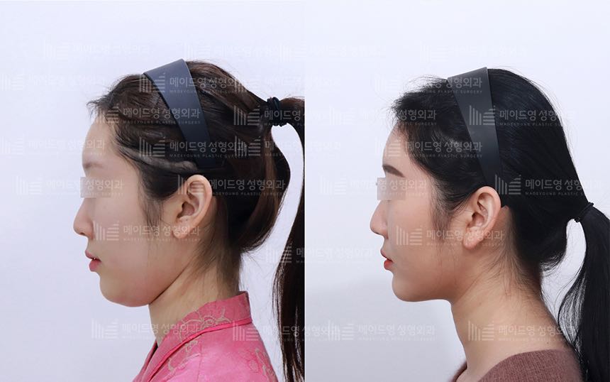 face lifting korea before after pictures - Lifting Before and After