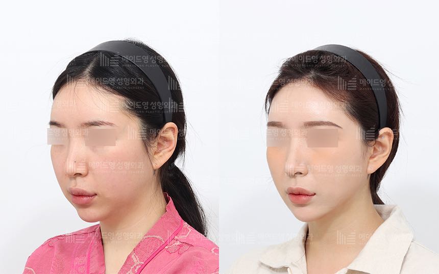 face lifting korea before after pictures - Lifting Before and After