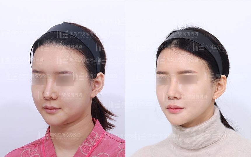 face lifting korea before after pictures - Lifting Before and After