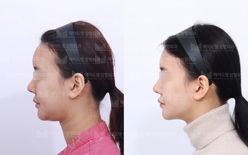 face lifting korea before after pictures - Lifting Before and After