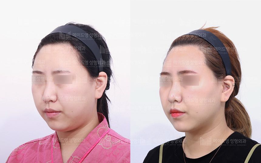 face lifting korea before after pictures - Lifting Before and After