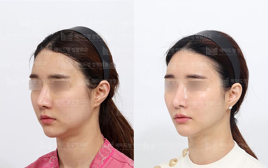 face lifting korea before after pictures - Lifting Before and After