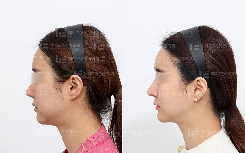 face lifting korea before after pictures - Lifting Before and After