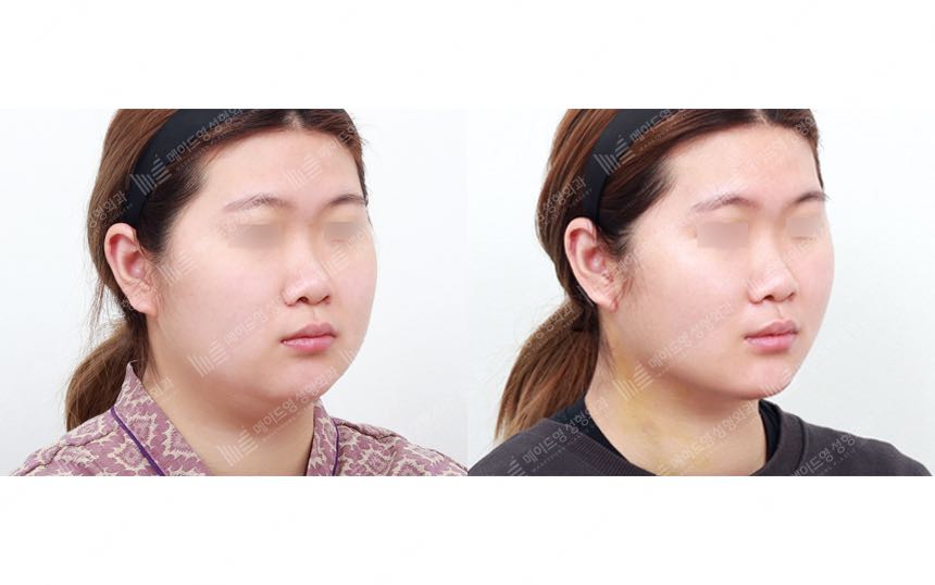 face lifting korea before after pictures - Lifting Before and After