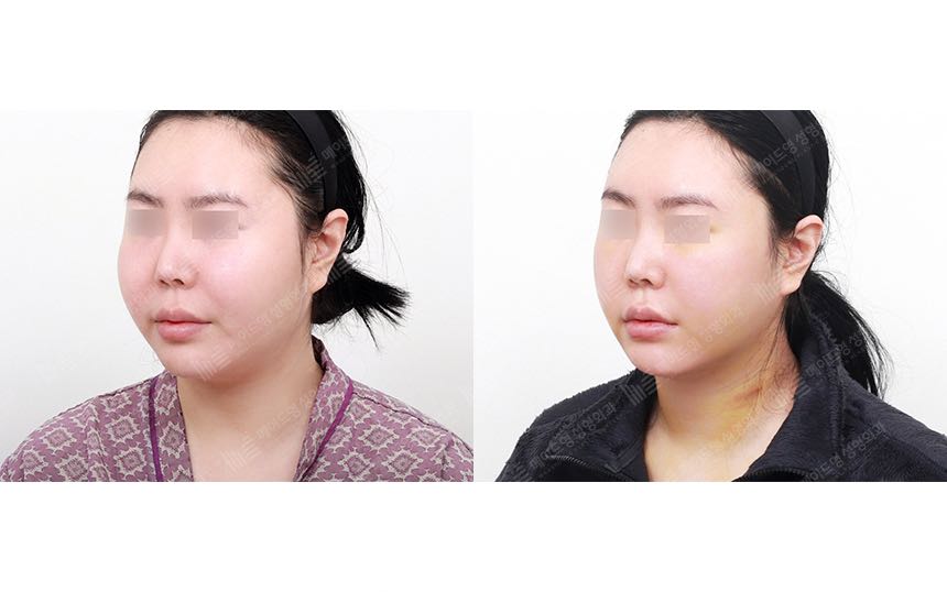 face lifting korea before after pictures - Lifting Before and After