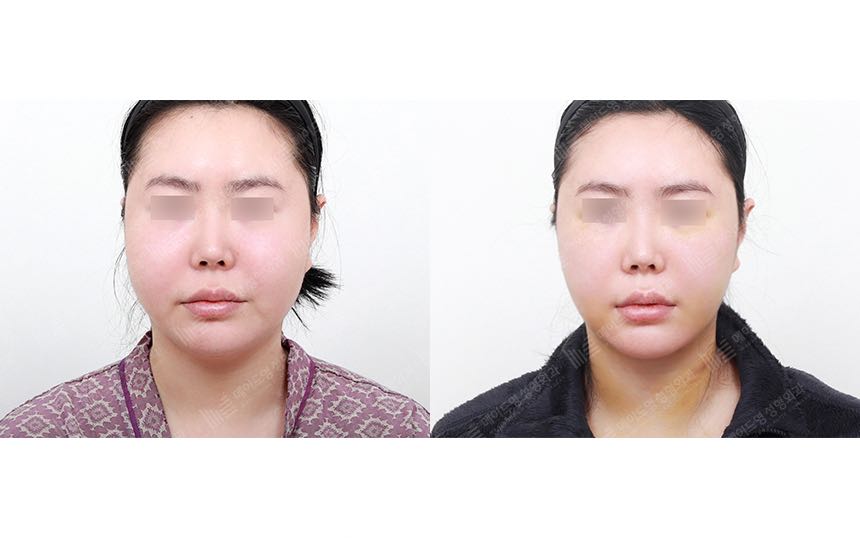 face lifting korea before after pictures - Lifting Before and After