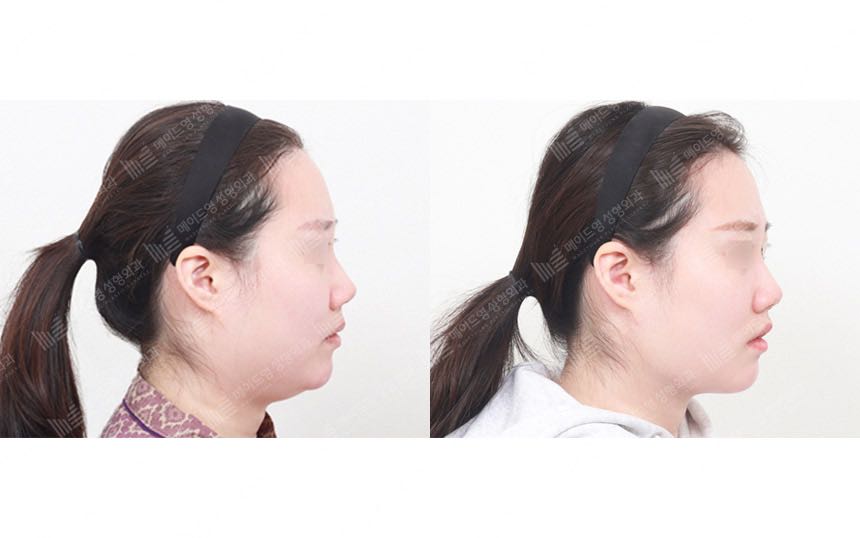 face lifting korea before after pictures - Lifting Before and After