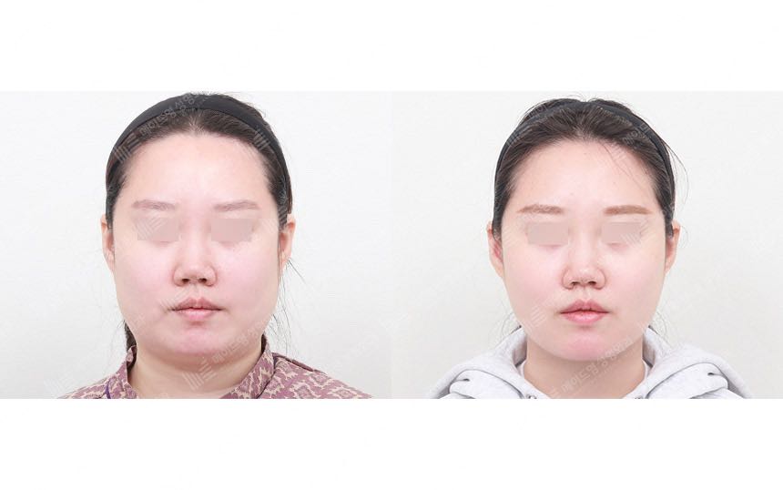 face lifting korea before after pictures - Lifting Before and After