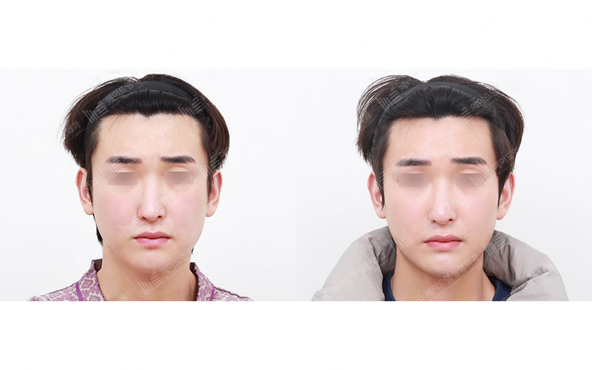 face lifting korea before after pictures - Lifting Before and After