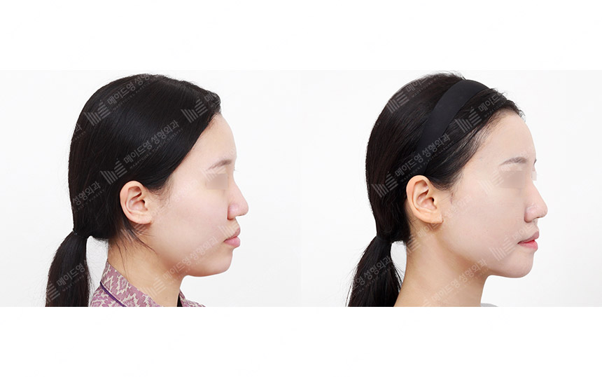 face lifting korea before after pictures - Lifting Before and After