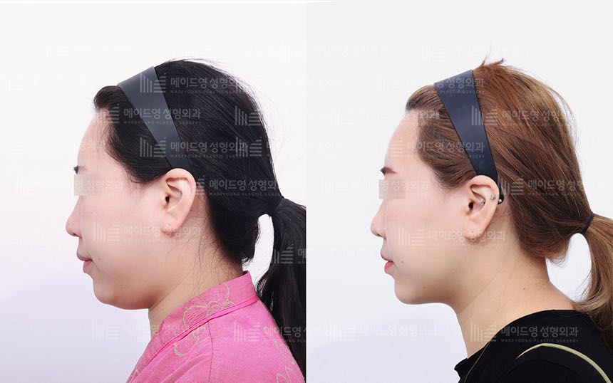 face lifting korea before after pictures - Lifting Before and After