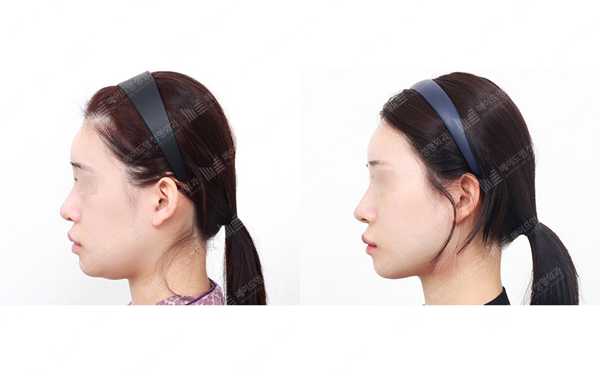 face lifting korea before after pictures - Lifting Before and After