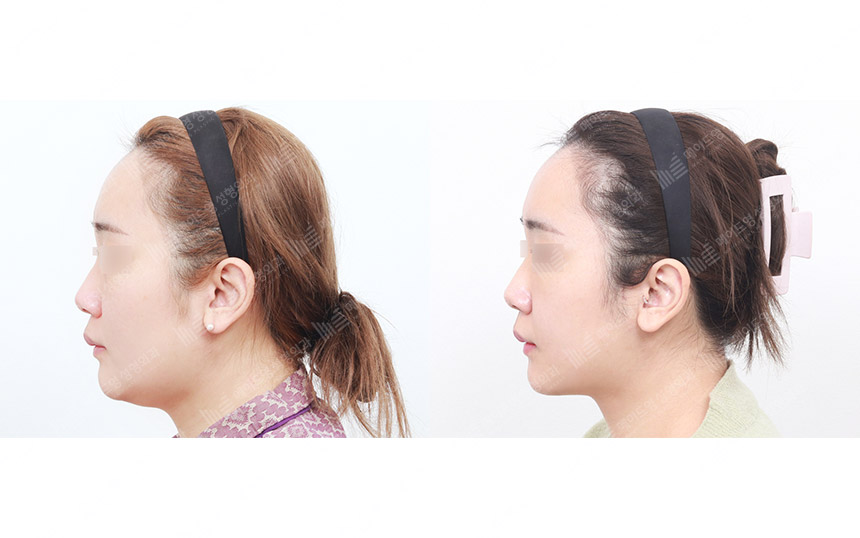 face lifting korea before after pictures - Lifting Before and After