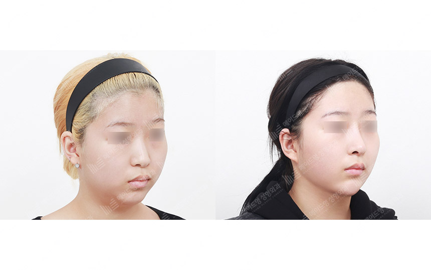 face lifting korea before after pictures - Lifting Before and After