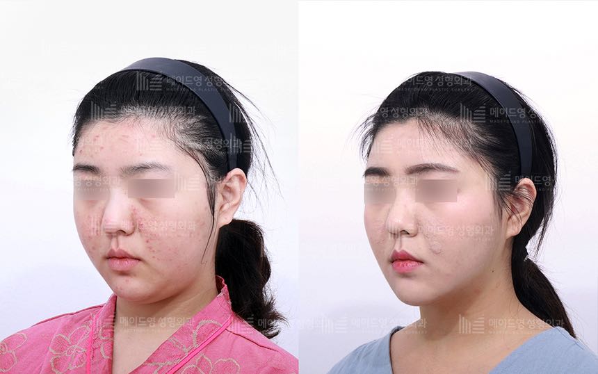 face lifting korea before after pictures - Lifting Before and After