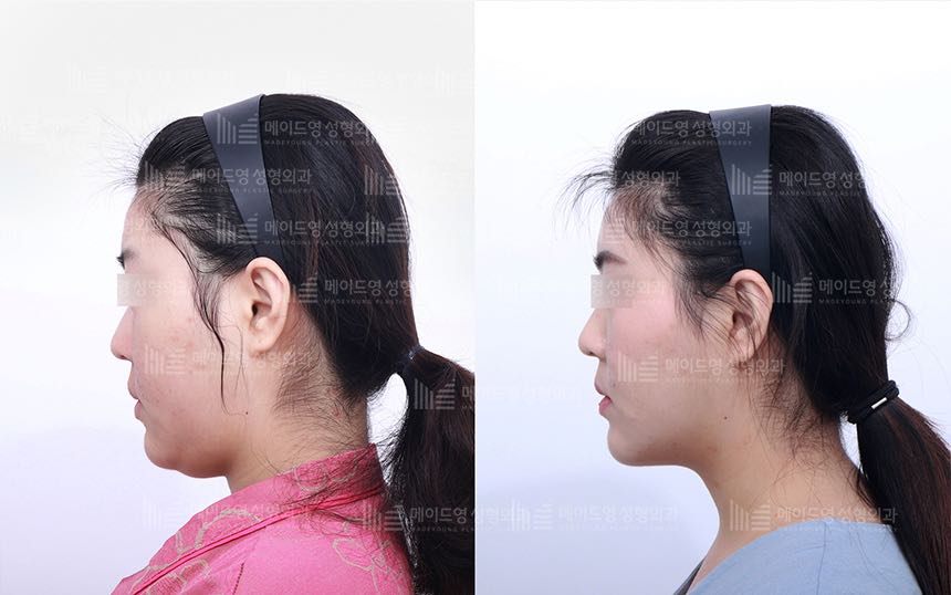 face lifting korea before after pictures - Lifting Before and After