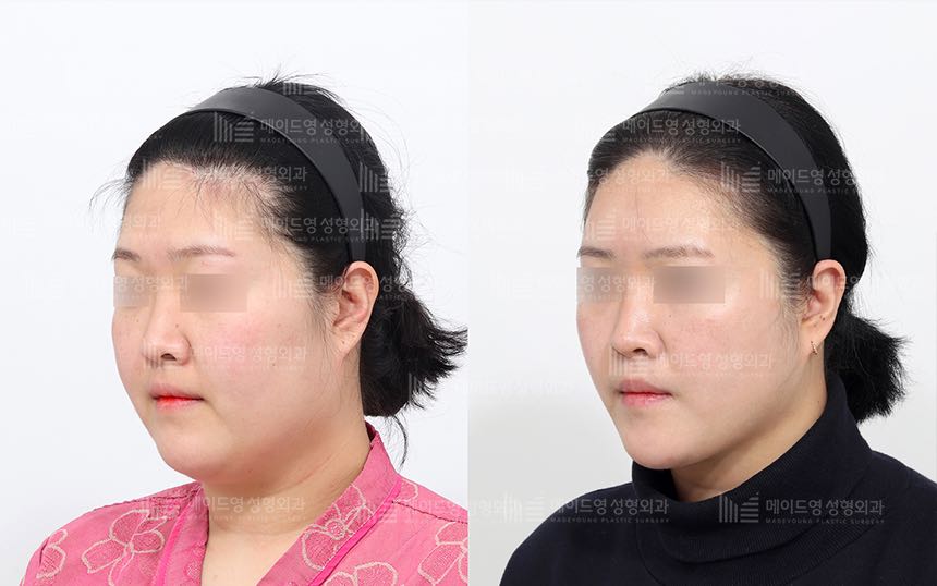 face lifting korea before after pictures - Lifting Before and After