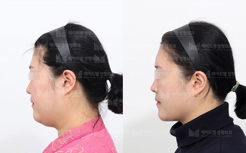 face lifting korea before after pictures - Lifting Before and After