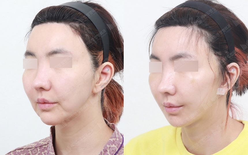face lifting korea before after pictures - Lifting Before and After