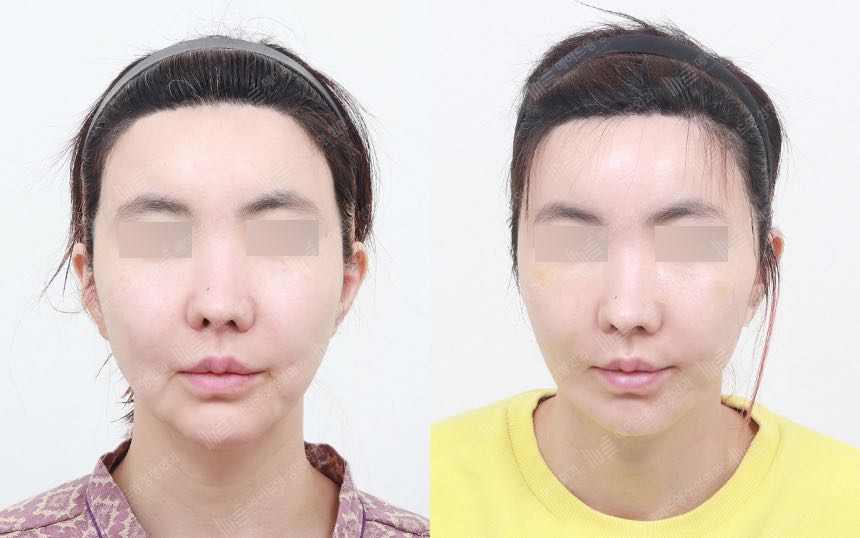 face lifting korea before after pictures - Lifting Before and After