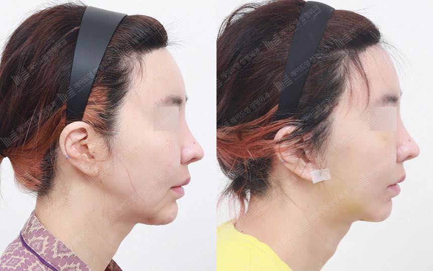 face lifting korea before after pictures - Lifting Before and After