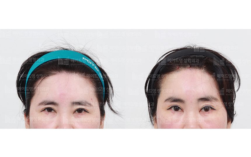 face lifting korea before after pictures - Lifting Before and After