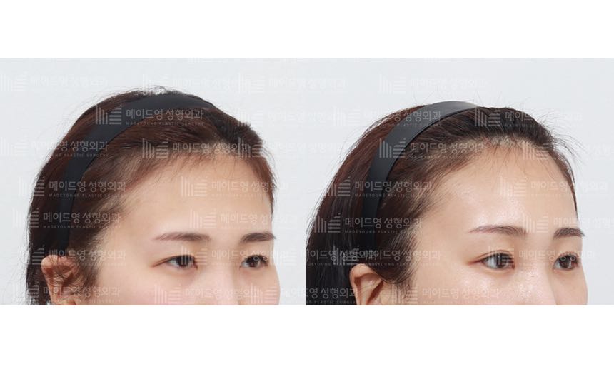 face lifting korea before after pictures - Lifting Before and After