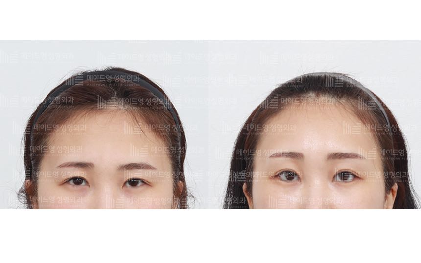 face lifting korea before after pictures - Lifting Before and After