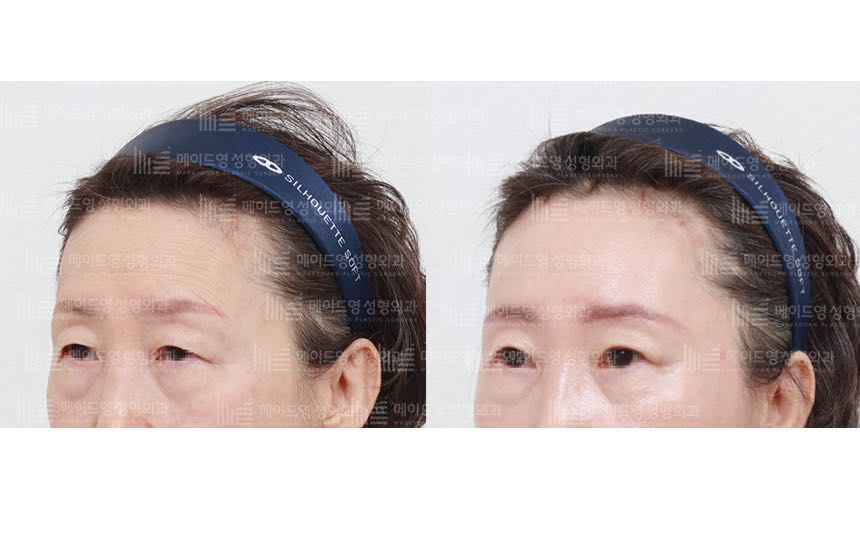 face lifting korea before after pictures - Lifting Before and After