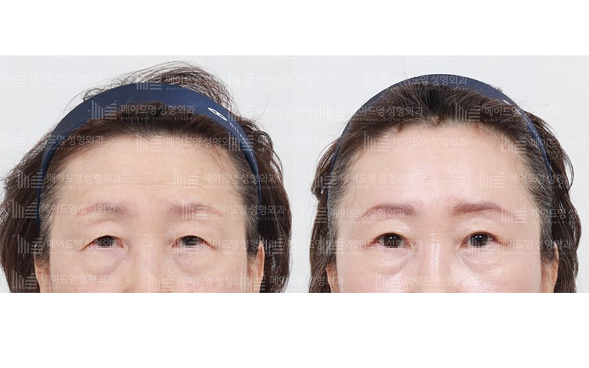 face lifting korea before after pictures - Lifting Before and After