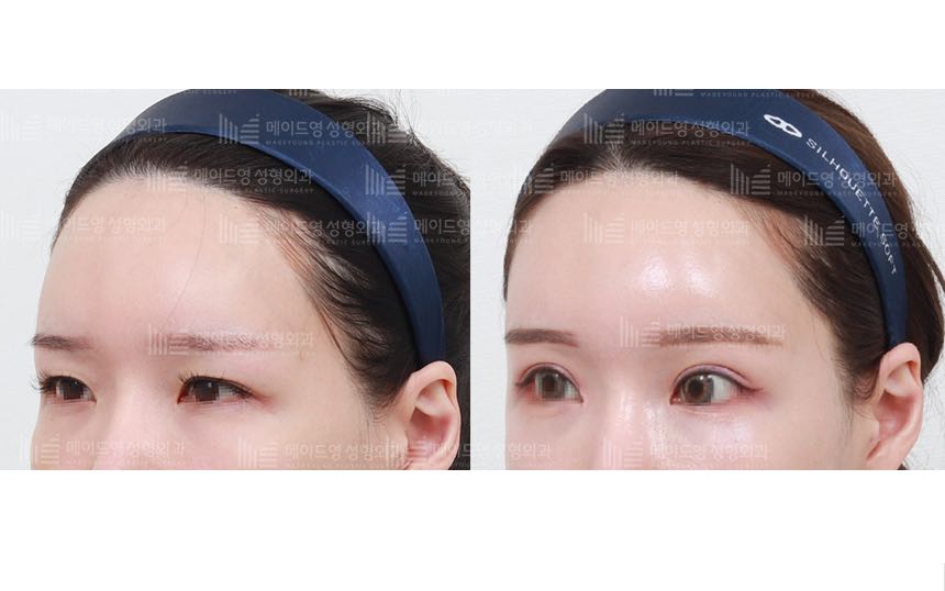 face lifting korea before after pictures - Lifting Before and After