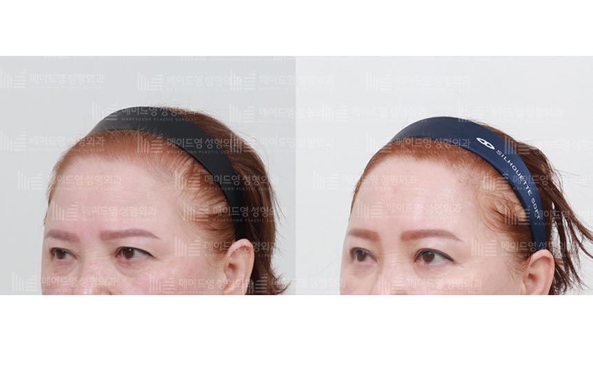 face lifting korea before after pictures - Lifting Before and After