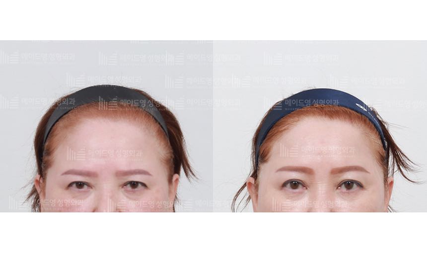 face lifting korea before after pictures - Lifting Before and After
