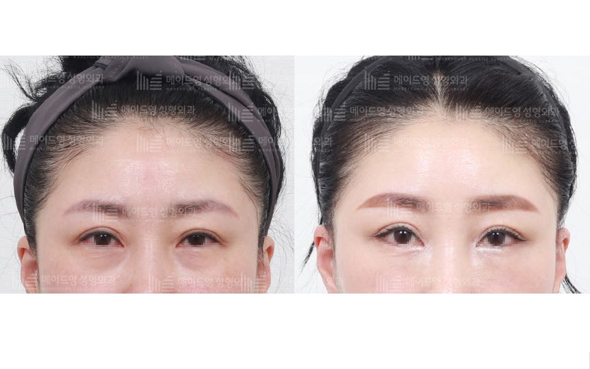 face lifting korea before after pictures - Lifting Before and After