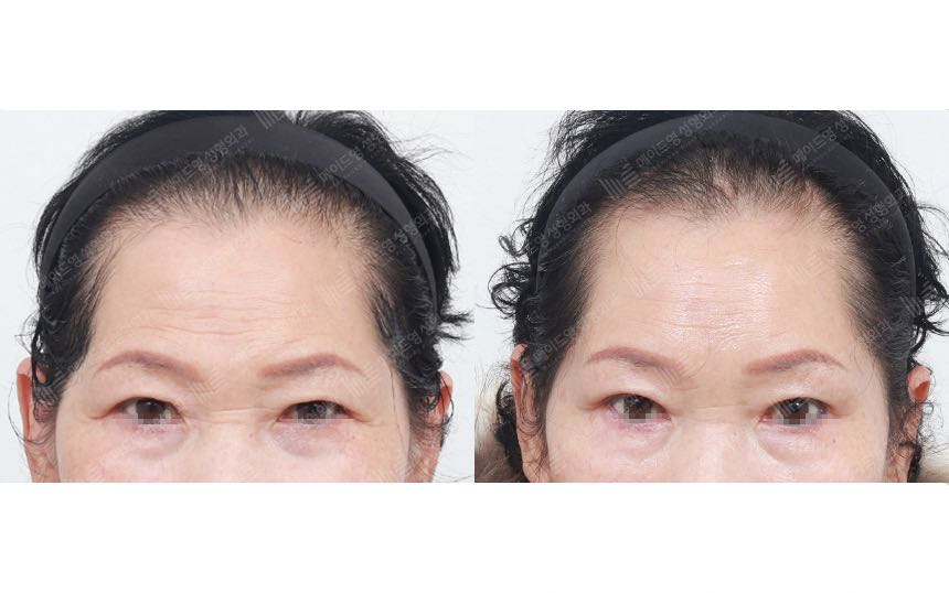 face lifting korea before after pictures - Lifting Before and After