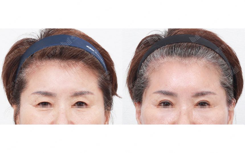 face lifting korea before after pictures - Lifting Before and After