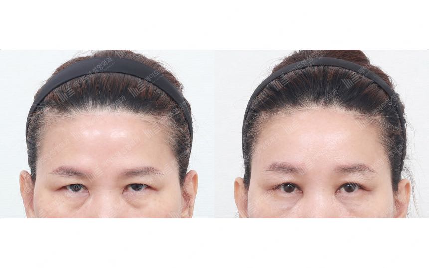 face lifting korea before after pictures - Lifting Before and After