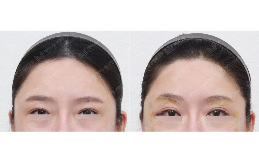face lifting korea before after pictures - Lifting Before and After