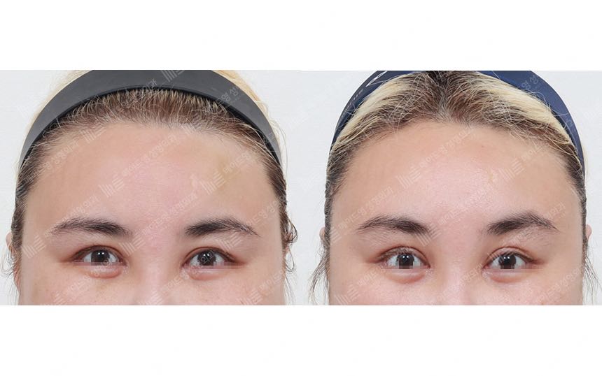face lifting korea before after pictures - Lifting Before and After