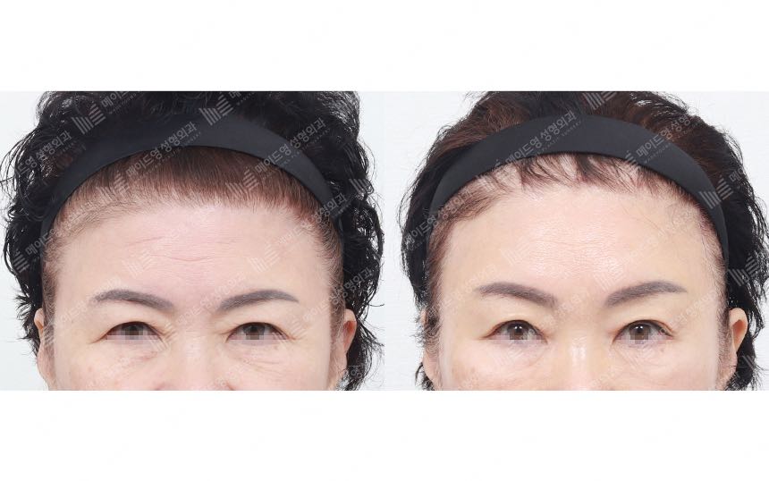 face lifting korea before after pictures - Lifting Before and After