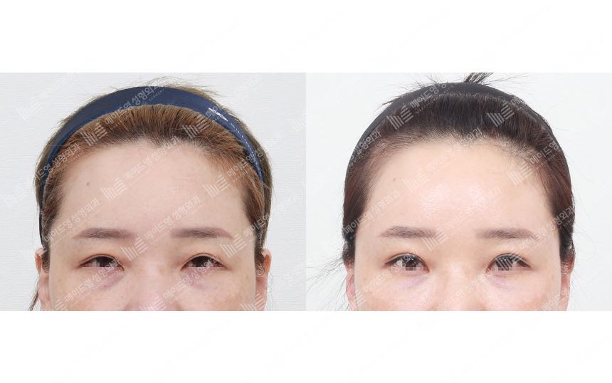 face lifting korea before after pictures - Lifting Before and After