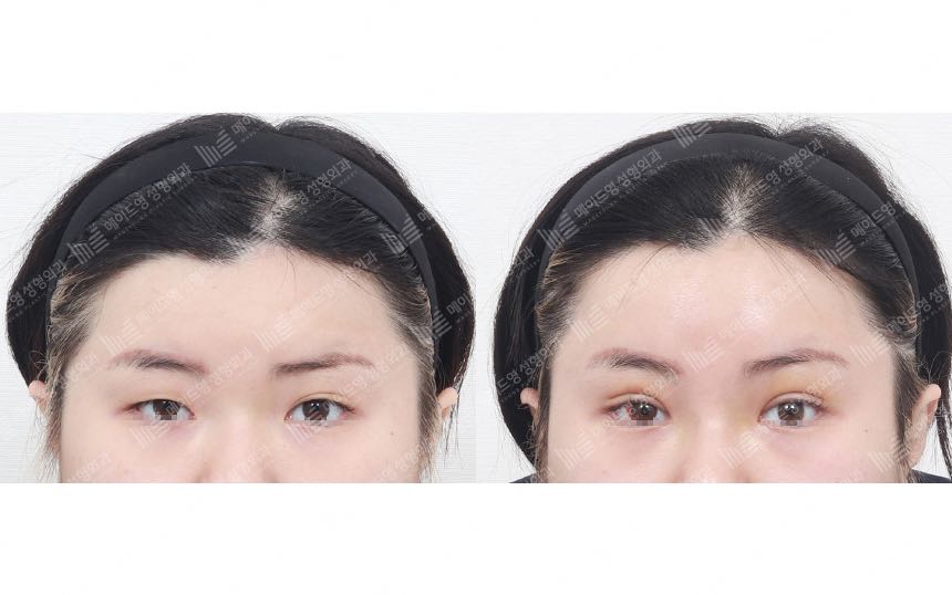 face lifting korea before after pictures - Lifting Before and After