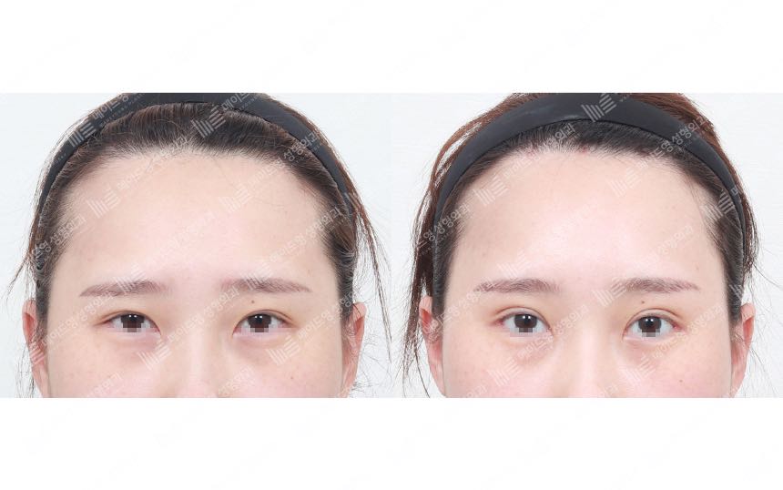 face lifting korea before after pictures - Lifting Before and After