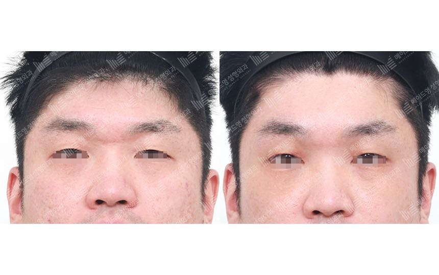 face lifting korea before after pictures - Lifting Before and After