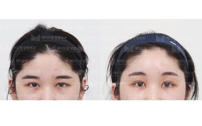 face lifting korea before after pictures - Lifting Before and After