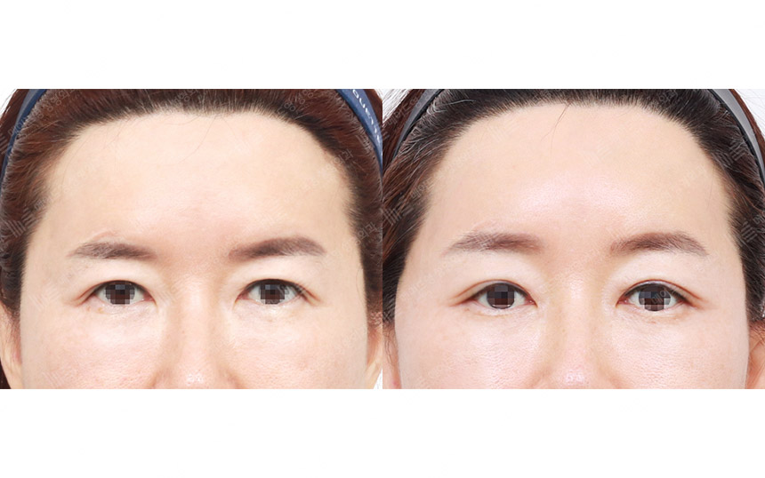 face lifting korea before after pictures - Lifting Before and After