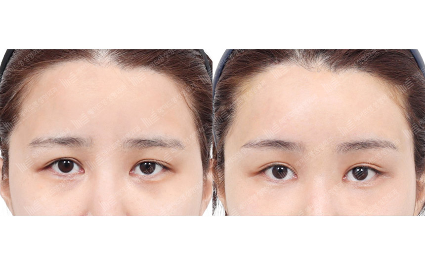 face lifting korea before after pictures - Lifting Before and After