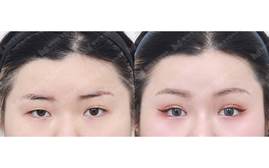 face lifting korea before after pictures - Lifting Before and After